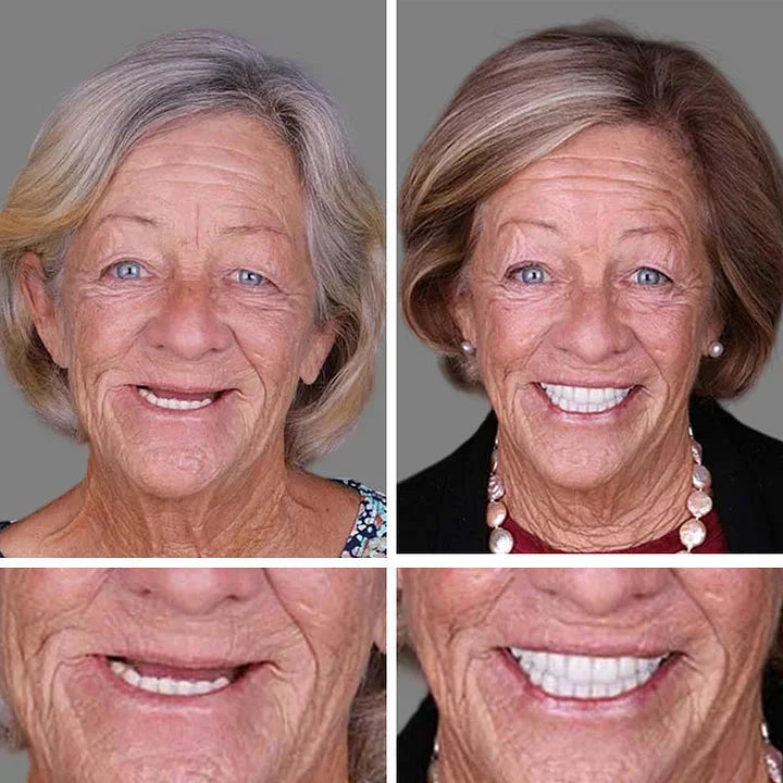 🌎Ends Today: 70% OFF! ⏰Medical Full Denture with Strong Suctiond🦷Obtain American Dental Association (ADA) Certification