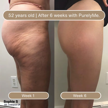 🏆Flash Sale⚡Anti-Cellulite Massage Oil