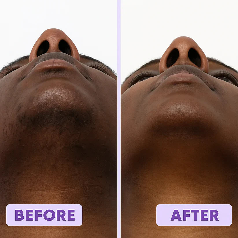 ⚡Erase Facial Hair in Minutes – No Pain, No Razor😍 Buy 1 Get 1 FREE Today!