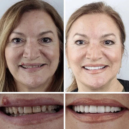 🌎Ends Today: 70% OFF! ⏰Medical Full Denture with Strong Suctiond🦷Obtain American Dental Association (ADA) Certification