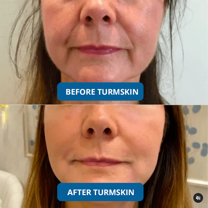 LIMITED OFFER: Buy 1 Get 1 FREE – 3% Hyaluronic Acid Serum for Deep Hydration & Glow