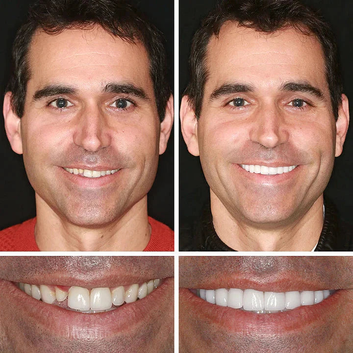 🌎Ends Today: 70% OFF! ⏰Medical Full Denture with Strong Suctiond🦷Obtain American Dental Association (ADA) Certification