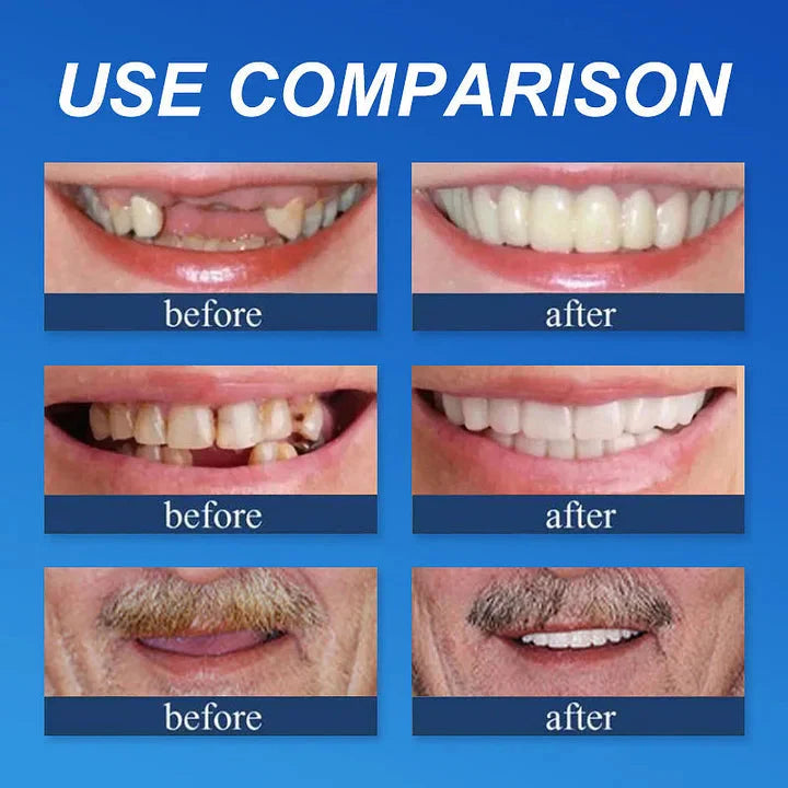 🌎Ends Today: 70% OFF! ⏰Medical Full Denture with Strong Suctiond🦷Obtain American Dental Association (ADA) Certification