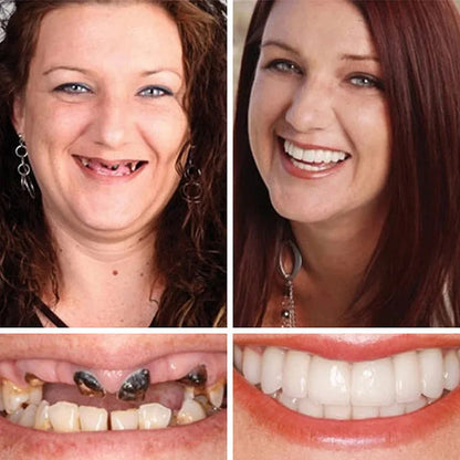 🌎Ends Today: 70% OFF! ⏰Medical Full Denture with Strong Suctiond🦷Obtain American Dental Association (ADA) Certification